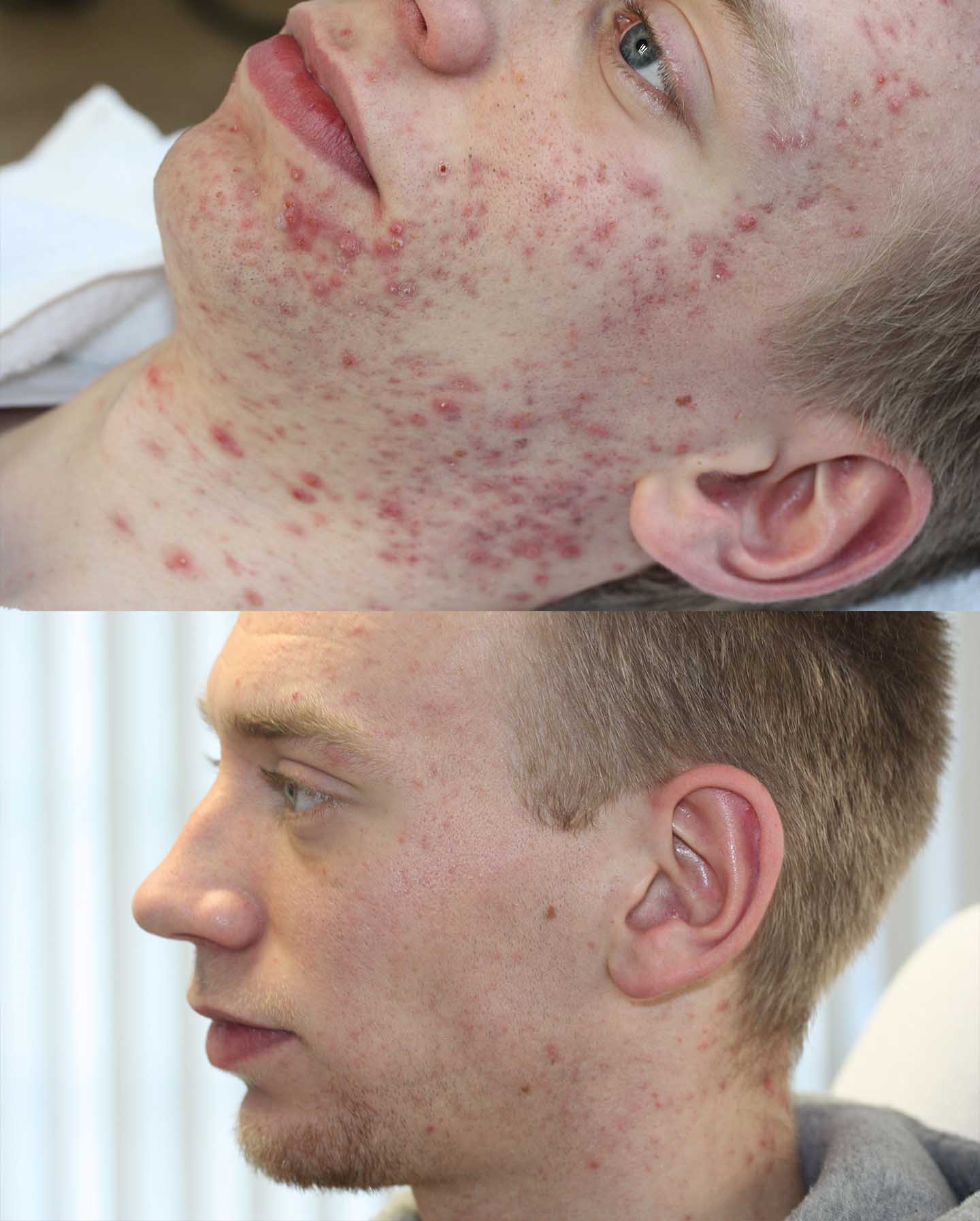 Beschrijving wolf aantrekkelijk Laserbehandeling voor acne(littekens)